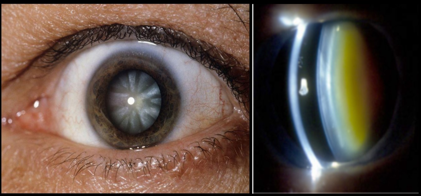 Cataract illustration