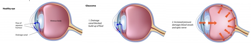 Glaucoma illustration