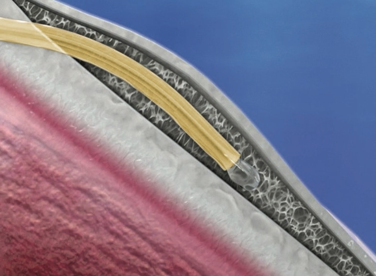 Intraocular lens implant
