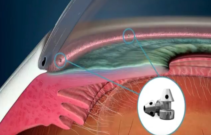 MIGS device illustration